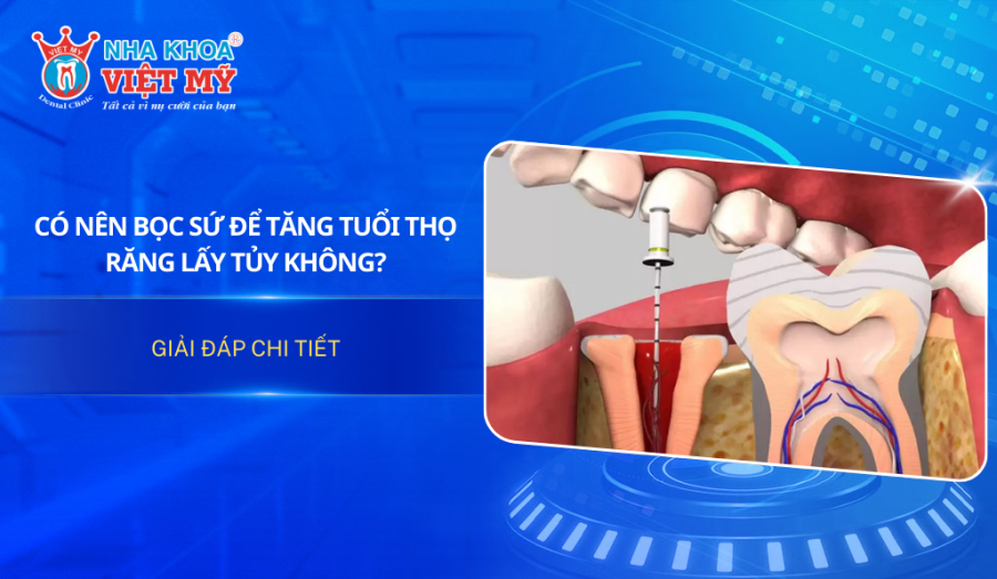 Có nên bọc sứ để tăng tuổi thọ răng lấy tủy không?