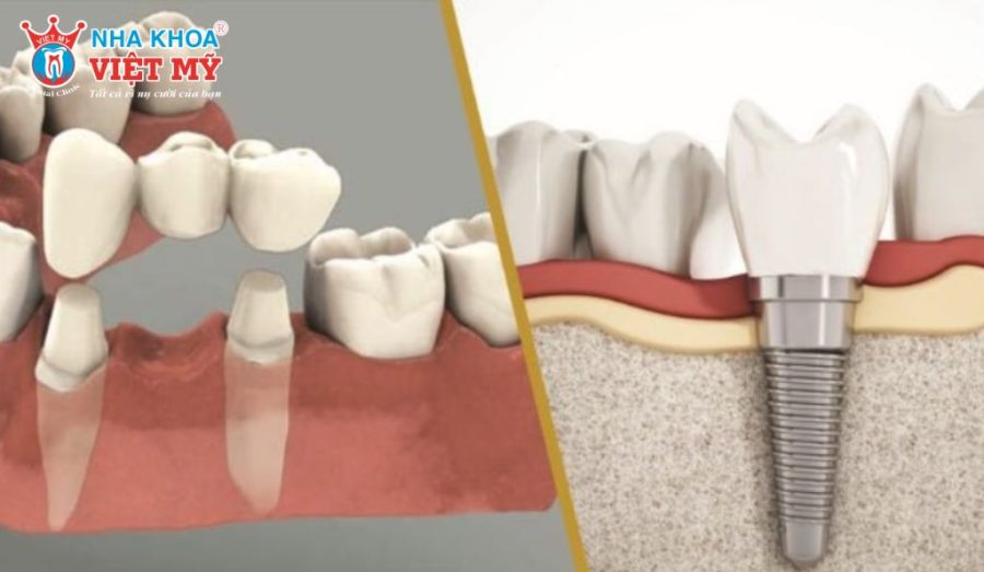 Trồng răng sứ vĩnh viễn bằng cầu răng sứ và trồng răng implant 