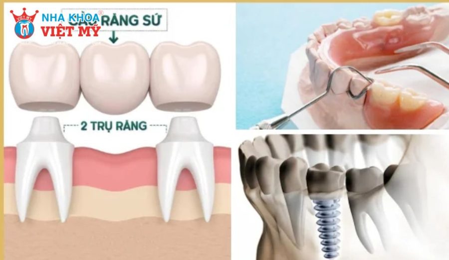 Phương pháp trồng răng (cầu răng sứ hay Implant)  ảnh hưởng trực tiếp đến chi phí trồng răng sứ