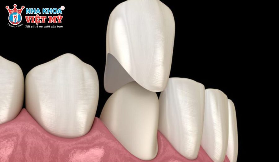 Bọc sứ giúp bảo vệ và kéo dài tuổi thọ răng sau khi lấy tủy.