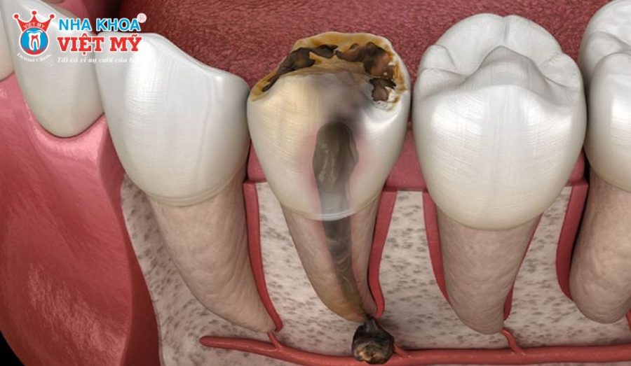 Mô răng bị phá hủy nhiều trước khi lấy tủy khiến răng suy giảm khả năng chịu lực và dễ nứt vỡ.