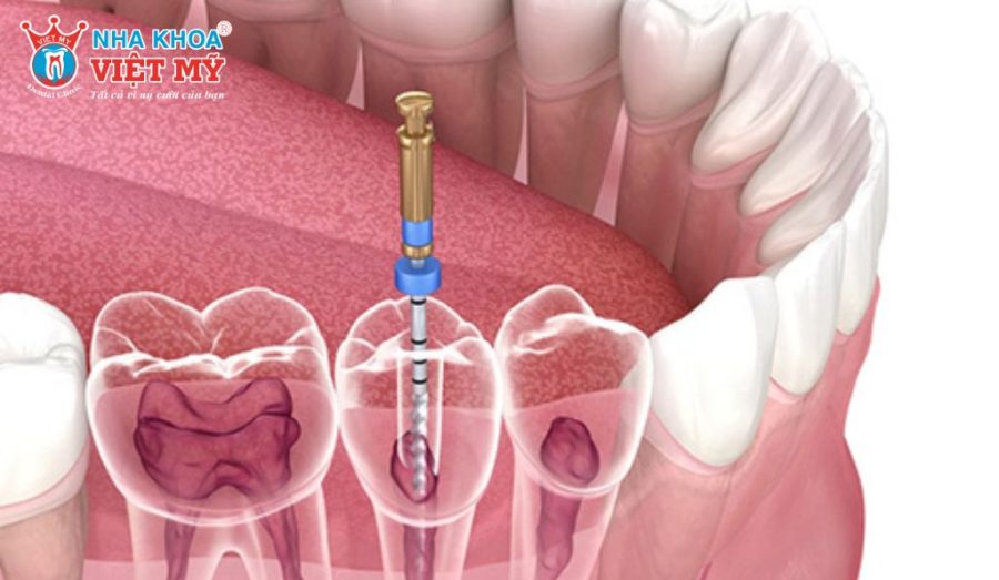 Tuổi thọ răng lấy tủy có thể kéo dài 10-20 năm nếu được phục hồi và chăm sóc đúng cách.