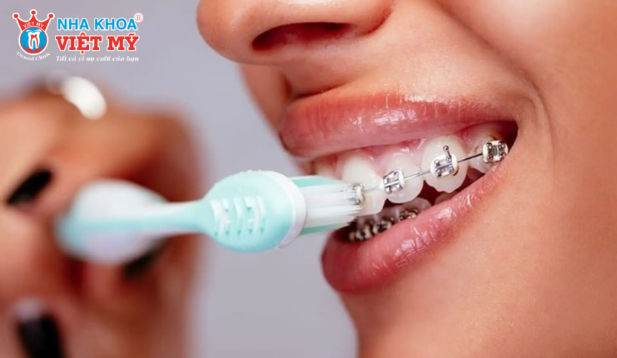 Bàn chải điện làm sạch hiệu quả mảng bám quanh mắc cài, dây cung và kẽ răng