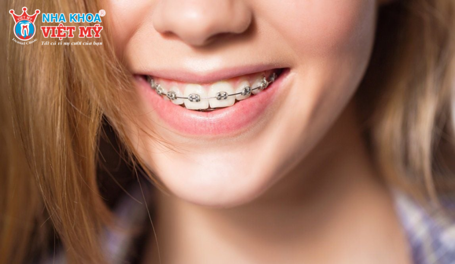 Nên thay mới bàn chải cho người niềng răng thường xuyên 