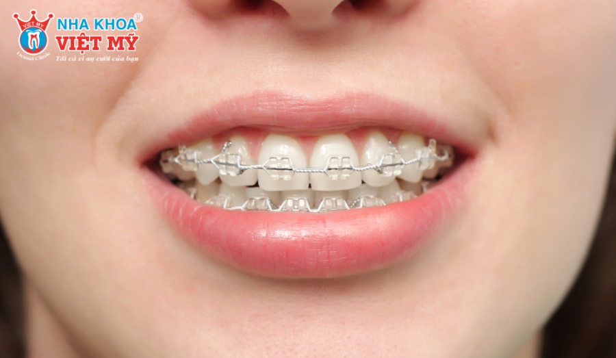 Nên tạo thói quen duy trì tần suất và thời gian chải răng khi niềng