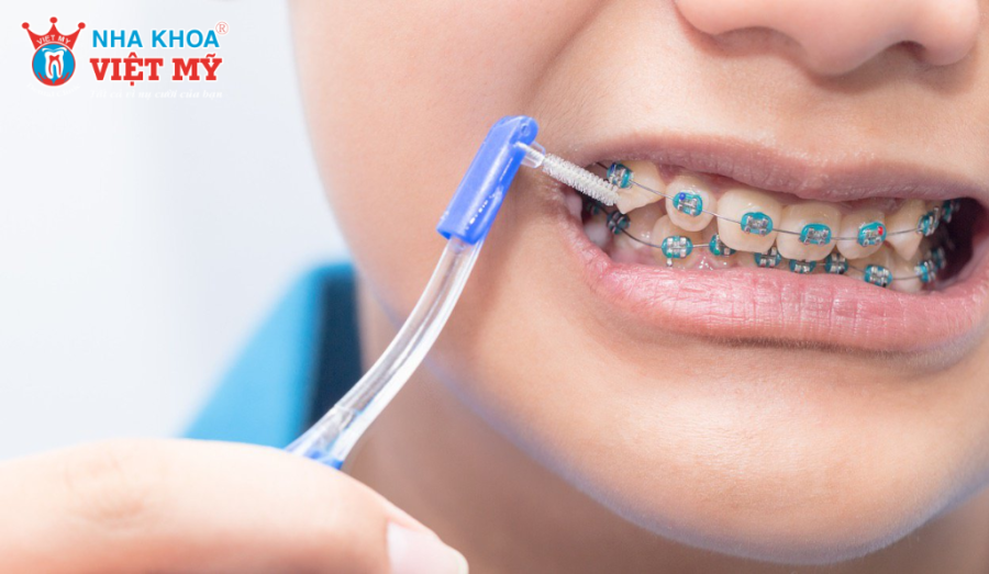 Từng loại bàn chải cho người niềng răng sẽ được sử dụng vào từng thời điểm 