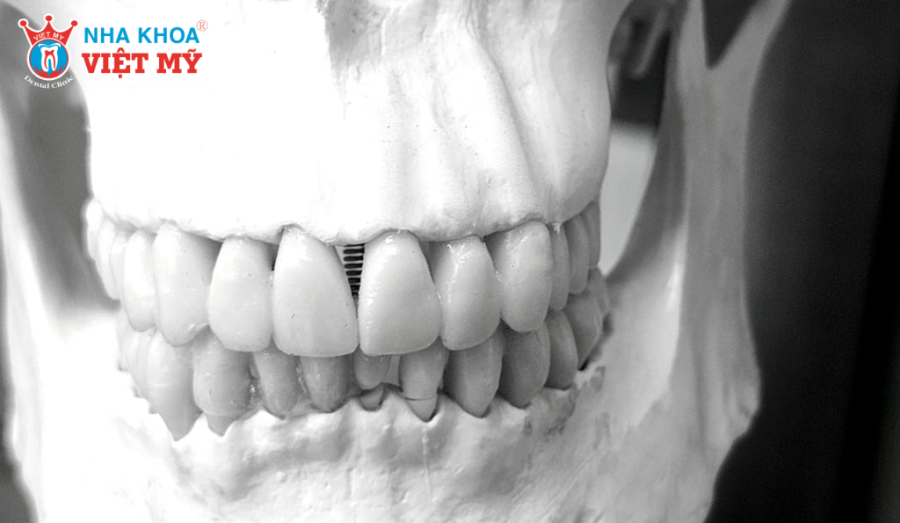 Giá Implant răng cửa thay đổi linh hoạt phụ thuộc nhiều yếu tố