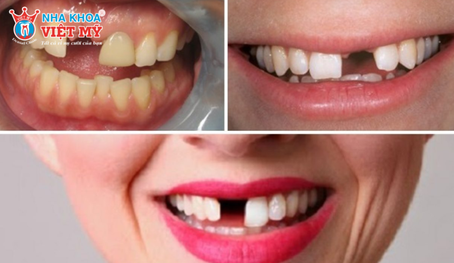 Khách hàng hiện nay thường ưu tiên chọn Implant răng cửa