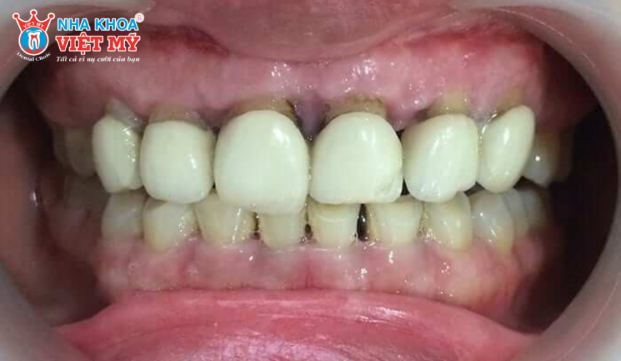 Cùi răng lộ rõ, dấu hiệu bị tụt lợi sau bọc răng sứ.