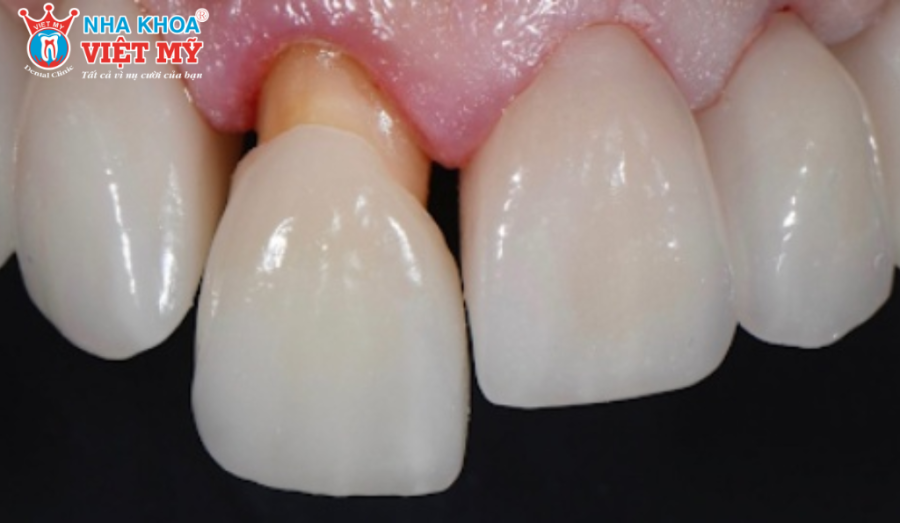 Bọc răng  sứ bị tụt lợi gây suy yếu răng thật và ảnh hưởng khả năng nâng đỡ mão sứ