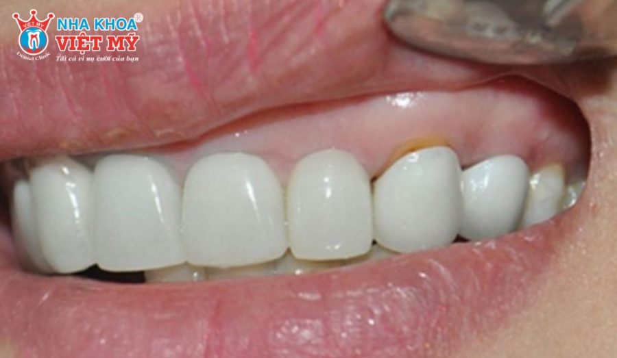 Kỹ thuật lấy dấu răng không chuẩn xác gây tụt lợi gây viêm lợi và vi khuẩn tích tụ ở viền răng sứ.