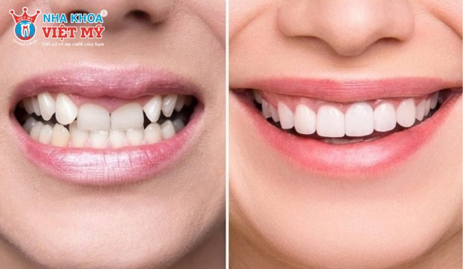 Răng bọc sứ không lấy tủy thường có độ bền và cảm giác ăn nhai tốt hơn so với răng đã lấy tủy.