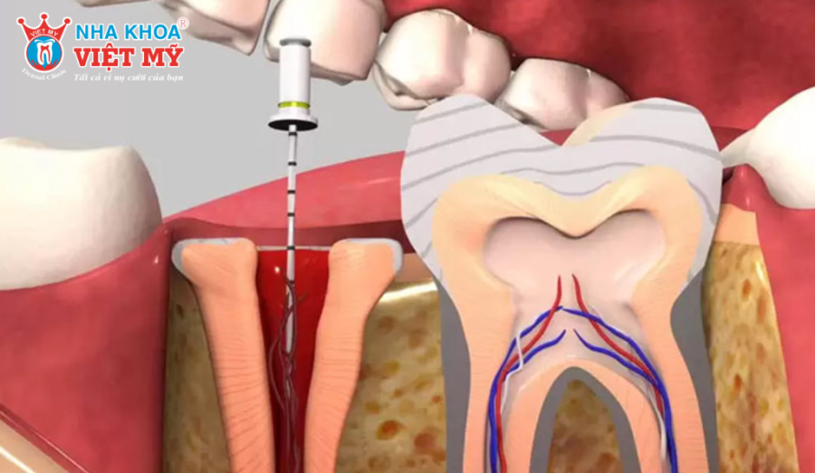 Không phải mọi trường hợp bọc răng sứ đều cần lấy tủy, bác sĩ sẽ chỉ định dựa trên tình trạng răng cụ thể.