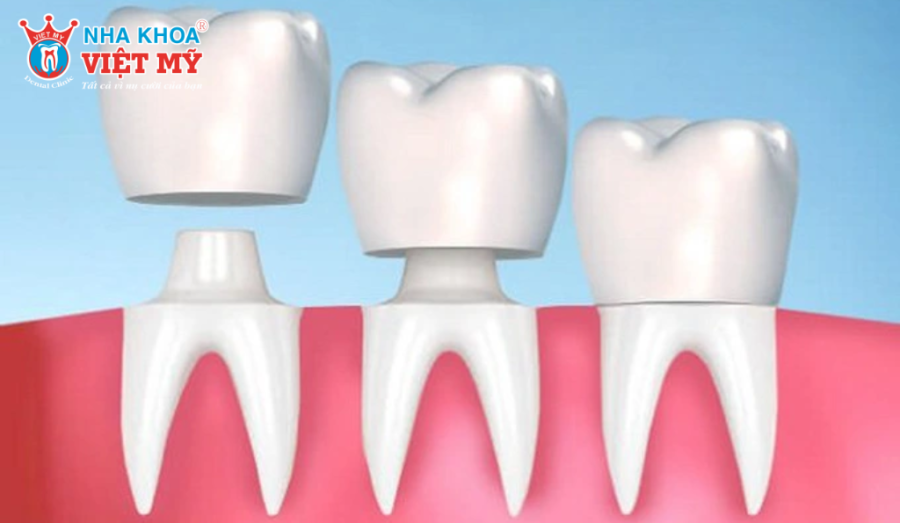 Bọc răng sứ không lấy tủy giúp bảo tồn răng thật nhưng đòi hỏi kỹ thuật mài chính xác cao.