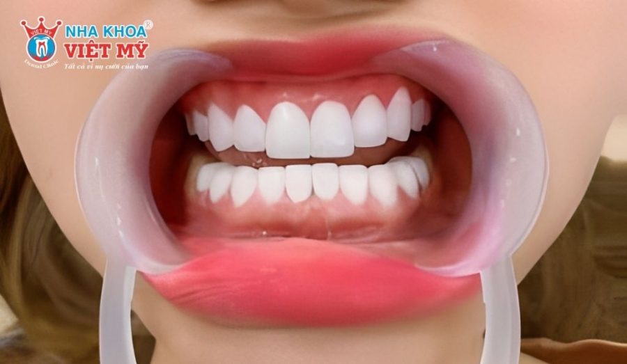 Bọc sứ răng cửa sẽ không gây ảnh hưởng gì về sau đến sức khỏe và tuổi thọ của răng