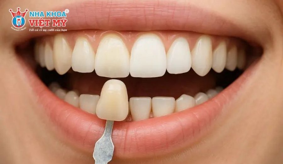 Chi phí khi bọc sứ cho 2 răng cửa