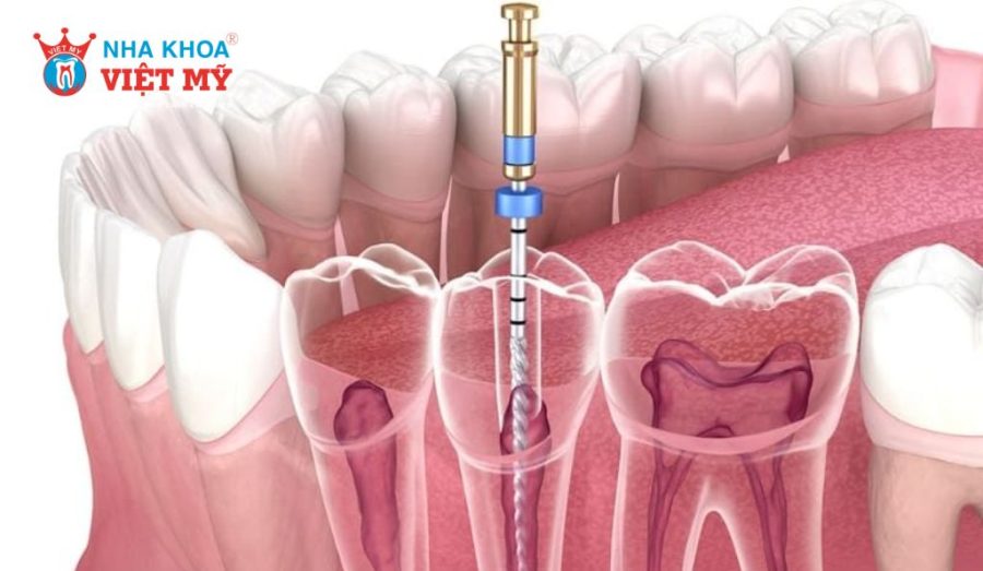 Chữa tủy cho răng đã bọc sứ thường đau nhức nhẹ trong 1 - 2 ngày đầu