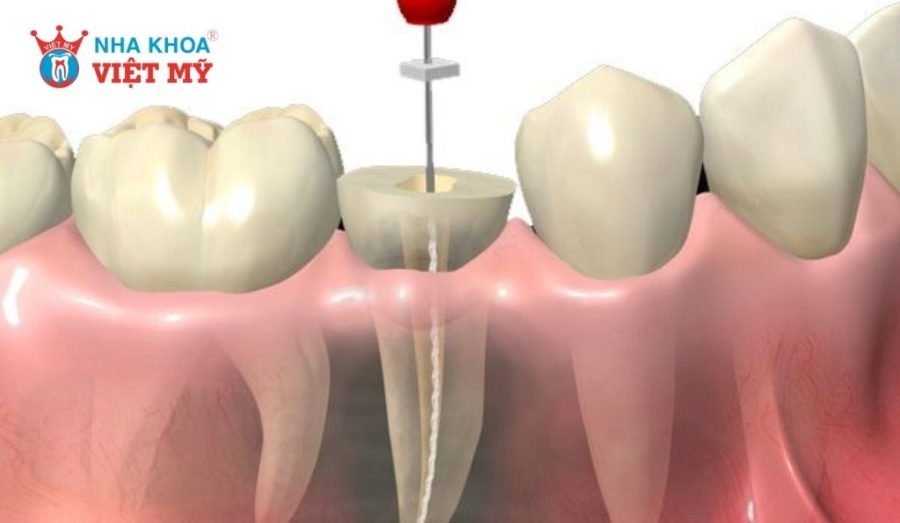 Những trường hợp được bác sĩ chỉ định chữa tủy cho răng đã bọc sứ