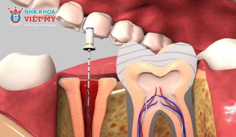 Răng bọc sứ chưa chữa tủy gây ảnh hưởng nghiêm trọng đến sức khỏe răng miệng