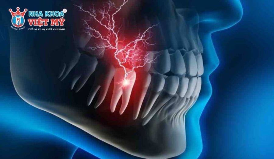 Răng bị viêm nhiễm nhưng không điều trị triệt để là nguyên nhân cần phải chữa tủy khi răng đã bọc sứ