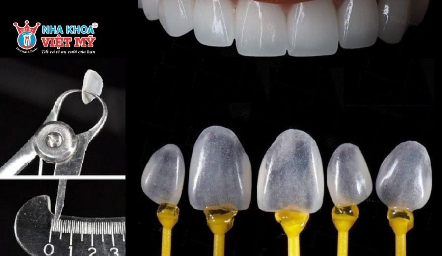 Kỹ thuật dán răng sứ bảo toàn cấu trúc răng thật