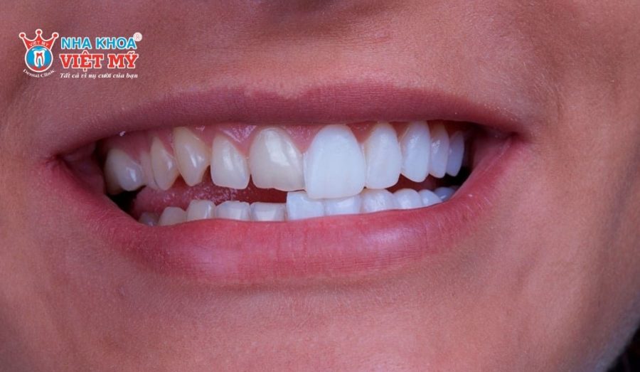 Dán răng sứ không mài giúp bảo tồn men răng tự nhiên