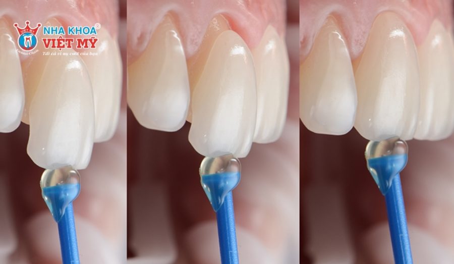 Dán răng sứ veneer phù hợp với tình trạng răng xỉn màu, không thể tẩy trắng