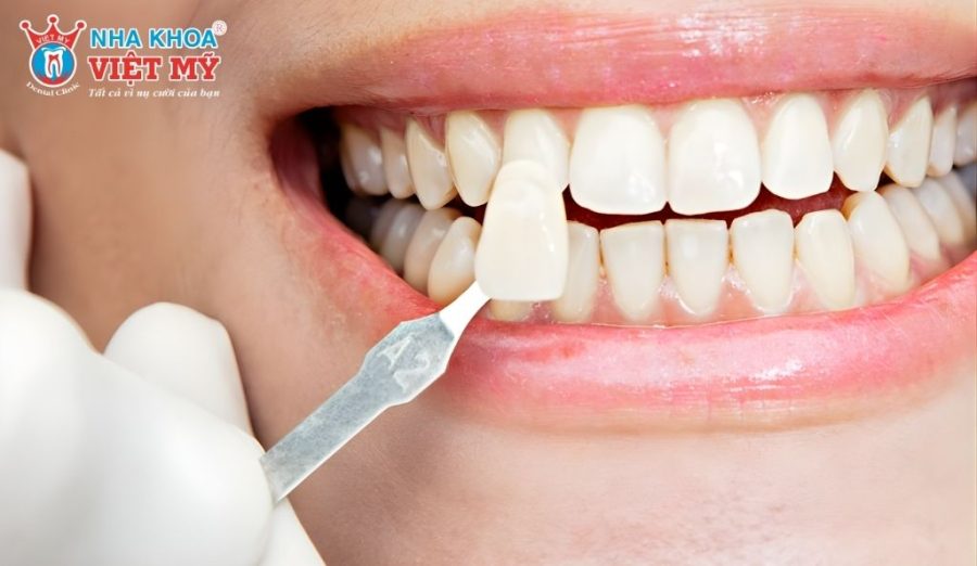 Dán sứ veneer không đúng kỹ thuật có thể tạo khe hở, khiến vi khuẩn tích tụ và gây hôi miệng