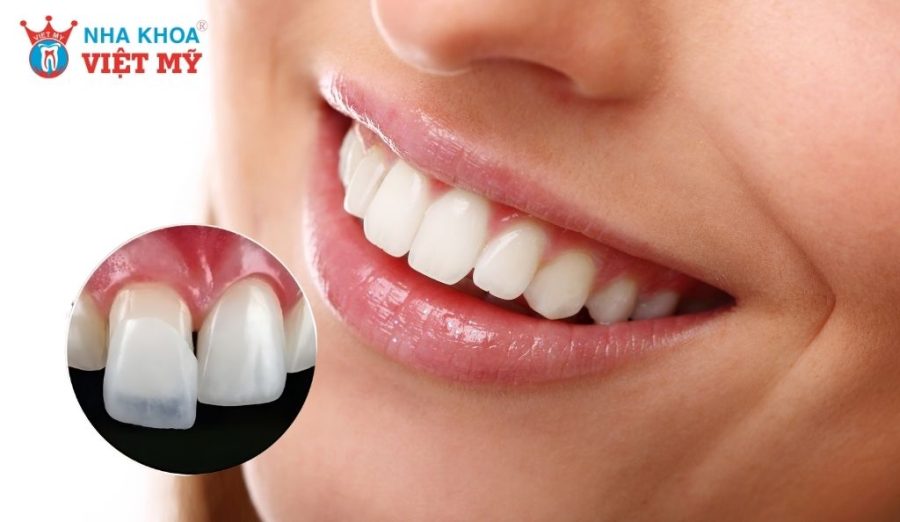 Chăm sóc răng miệng đúng cách để tránh hôi miệng sau khi dán sứ veneer