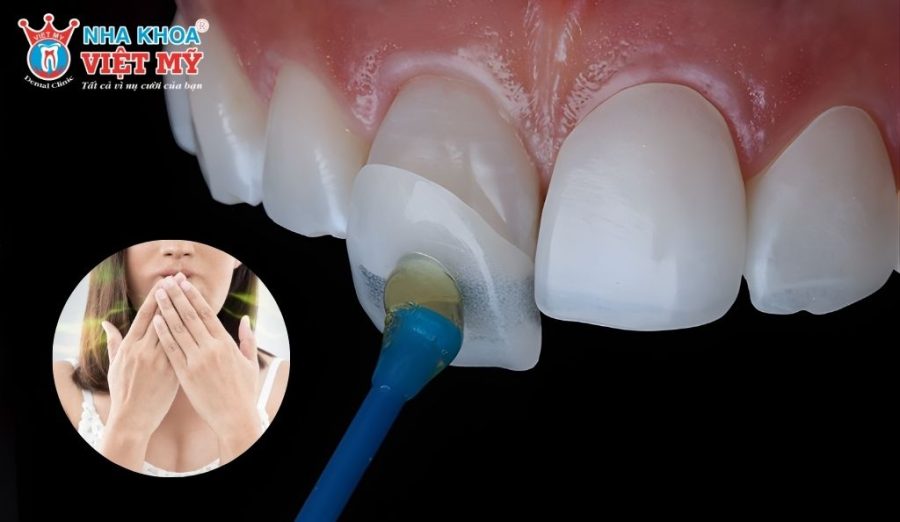 Dán sứ veneer chất lượng sẽ không gây ra hôi miệng