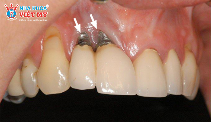 Trụ Implant bị đào thải khi cơ thể không chấp nhận vật liệu Titanium và quá trình tích hợp xương thất bại.