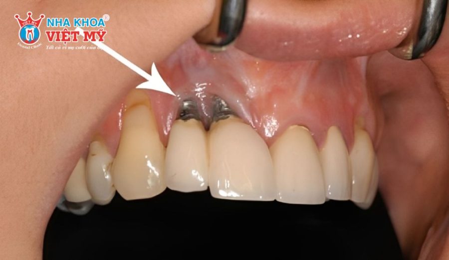 Trồng răng Implant giá rẻ tiềm ẩn nhiều rủi ro