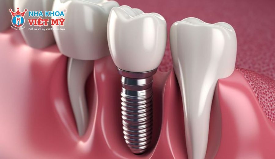  Thực hiện đúng hướng dẫn của bác sĩ trước và sau cấy ghép Implant giúp quá trình phục hồi diễn ra thuận lợi