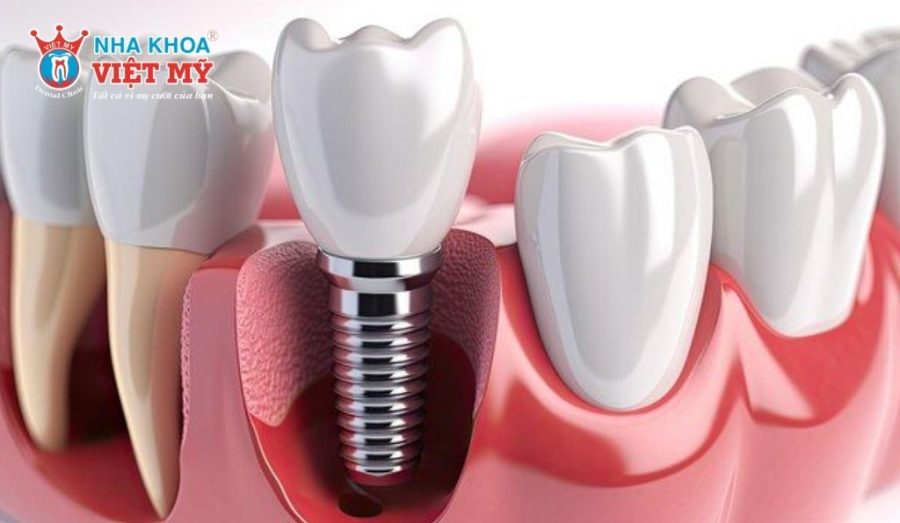 Ưu tiên lựa chọn loại trụ Implant chính hãng, có nguồn gốc xuất xứ rõ ràng