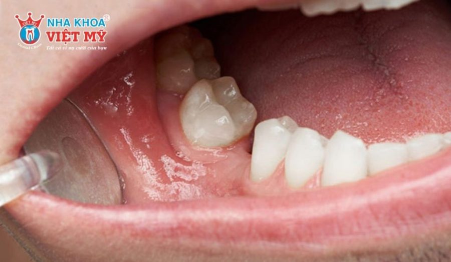 Mất răng và hậu quả khôn lường nếu không trồng răng sớm