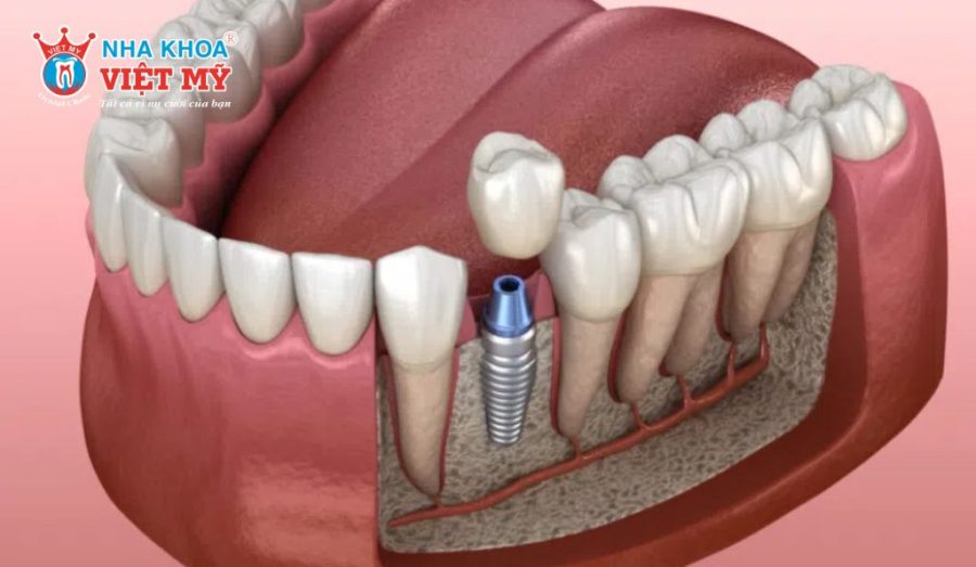 Xuất xứ của trụ Implant Biotem đến từ Hàn Quốc