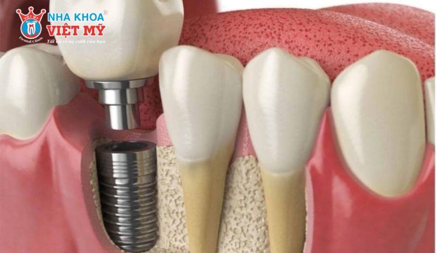 Implant Biotem chống chỉ định cho người có bệnh lý liên quan đến khả năng cầm máu
