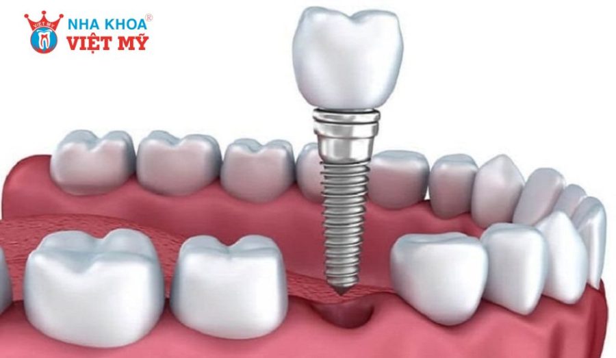 Implant Biotem có chi phí hợp lý hơn nhiều loại implant trên thị trường