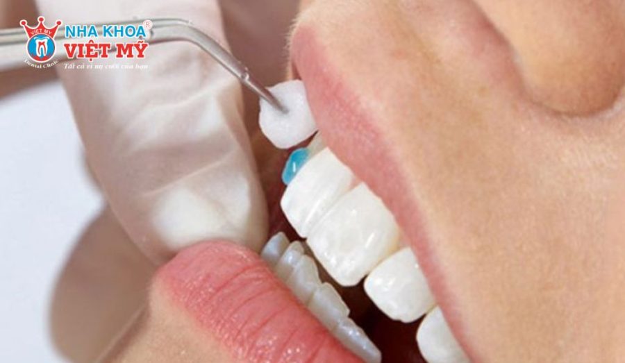 Keo dán răng sứ vĩnh viễn được sử dụng để cố định lâu dài mão sứ