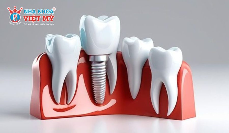 Làm cầu răng sứ trên trụ Implant là một lựa chọn phù hợp