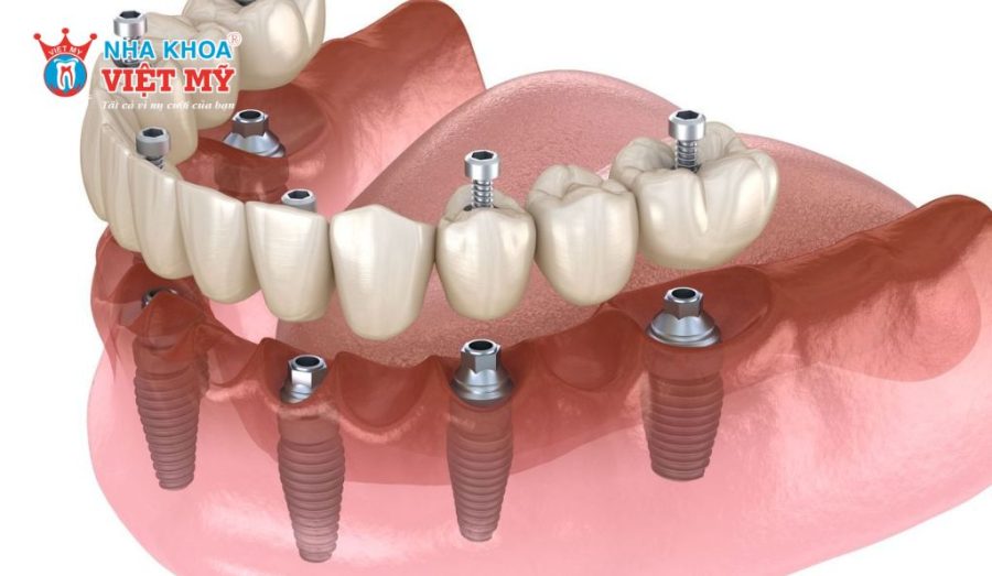 Khắc phục tình trạng tiêu xương hàm bằng phương pháp cấy ghép Implant