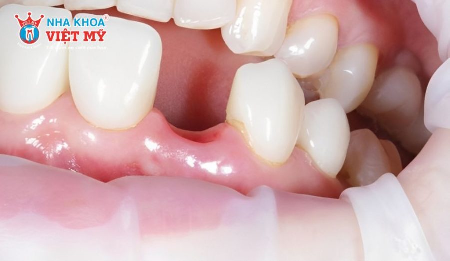 Làm cầu răng sứ không ngăn chặn được tình trạng tiêu xương hàm