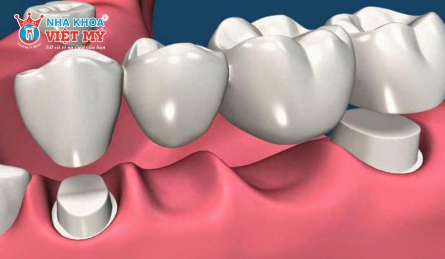 Mở rộng cầu răng sứ làm tăng nguy cơ hư hại cho các răng thật còn lại