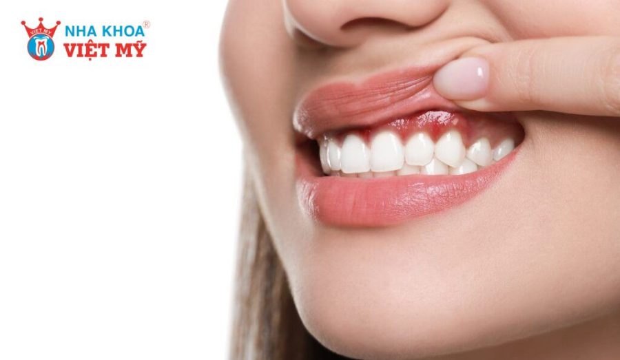 4 hậu quả tiêu xương có thể xảy ra khi phục hình bằng phương pháp cầu răng sứ