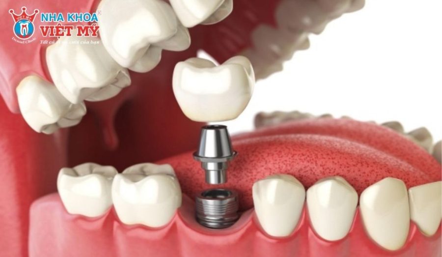 Phương pháp Neodent Implant có tính thẩm mỹ cao