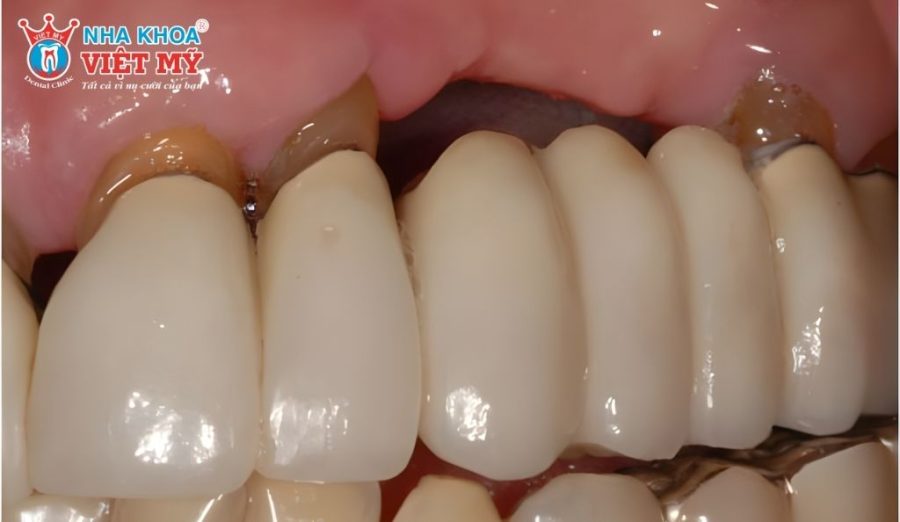 Cầu răng sứ không thay thế chân răng nên không ngăn được tiêu xương hàm