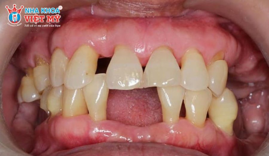Tiêu xương hàm, tụt nướu khiến cầu răng sứ kém hiệu quả và dễ phát sinh biến chứng