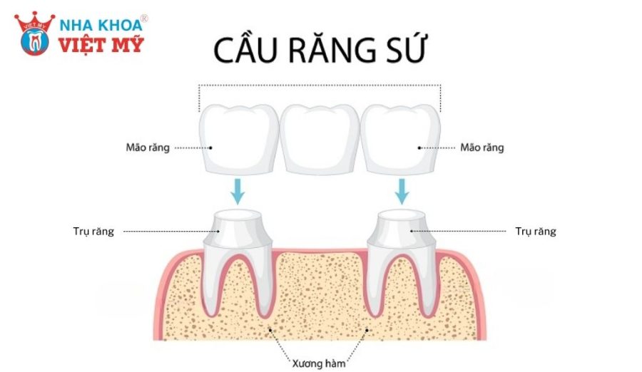 Cầu răng sứ là phương pháp phục hình một hoặc nhiều răng mất liền kề