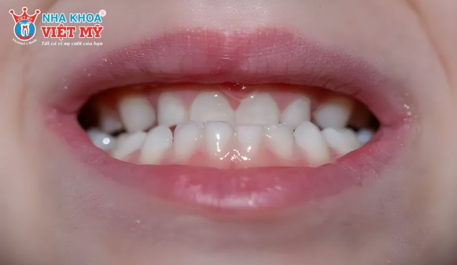 Nên thăm khám chuyên khoa để xác định đúng nguyên nhân gây móm răng