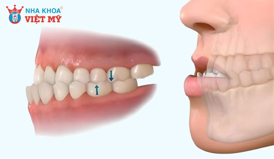  Móm răng khiến hai hàm mất cân đối do khớp cắn phát triển ngược